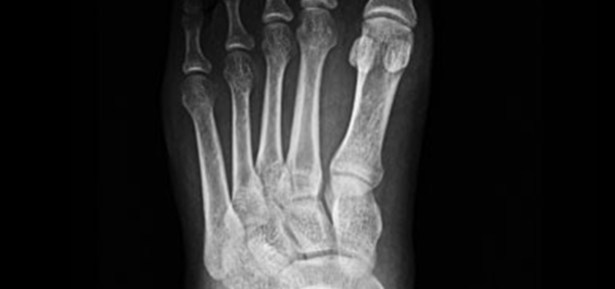 STRESS FRACTURE OF THE FOOT