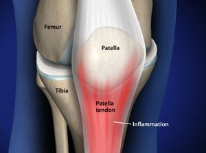 Knee Pain Treatment Reservoir